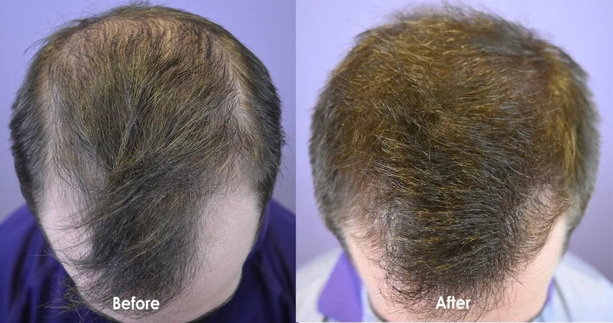 🧴 TÓNICO ANTICAÍDA MINOXIDIL PARA HOMBRES