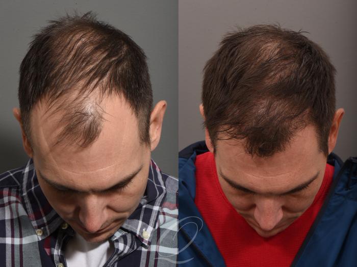 🧴 TÓNICO ANTICAÍDA MINOXIDIL PARA HOMBRES