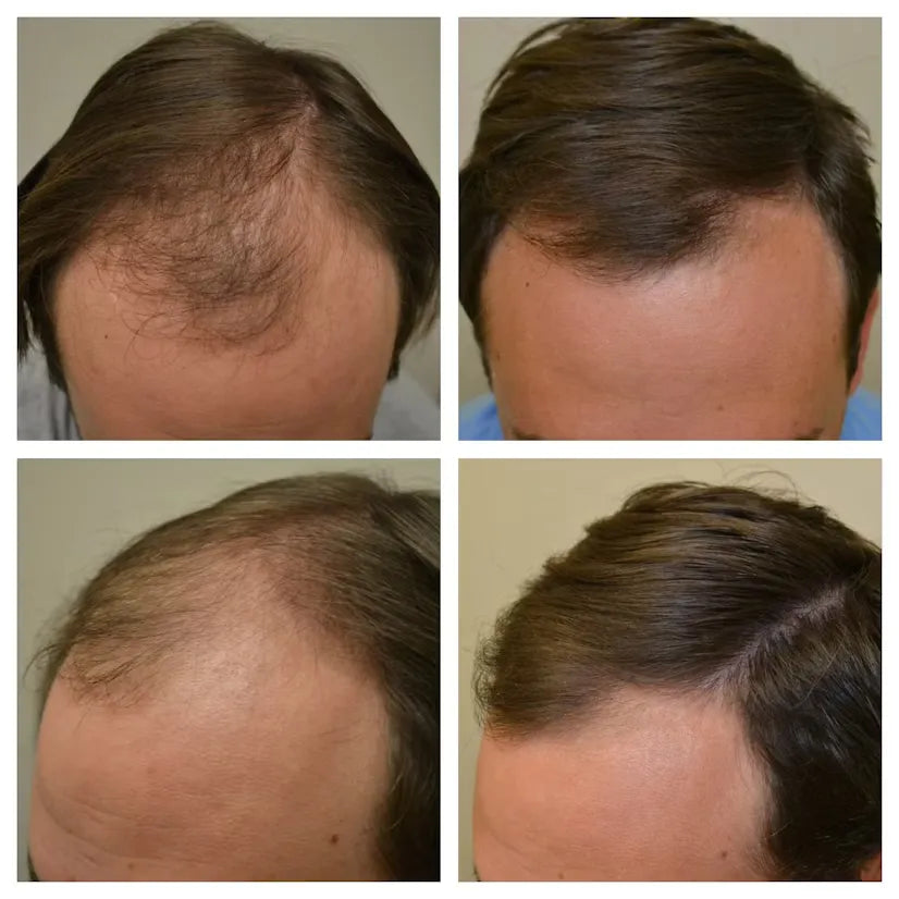 🧴 TÓNICO ANTICAÍDA MINOXIDIL PARA HOMBRES